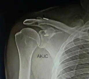 Post Surgery Xray of Acromio Clavicular Joint Reconstruction