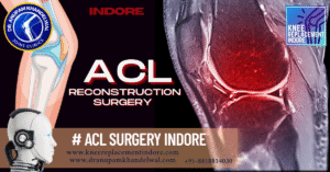 Best ACL Reconstruction Surgery in Indore