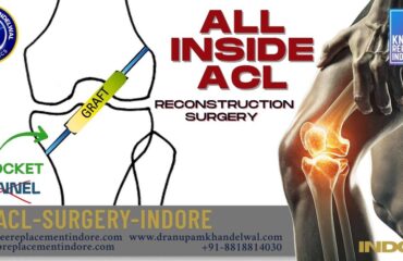 All Inside ACL reconstruction Surgery - Dr. Anupam Khandelwal