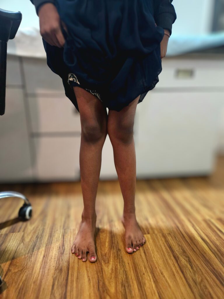 clinical picture of Knock Knees in 11 year old patient - Dr. Anupam Khandelwal