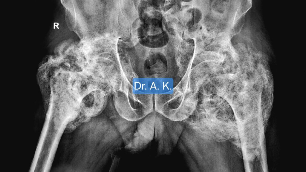 An X-ray of Pelvis with both hips showing advanced Myositis ossificans of both hip joints
