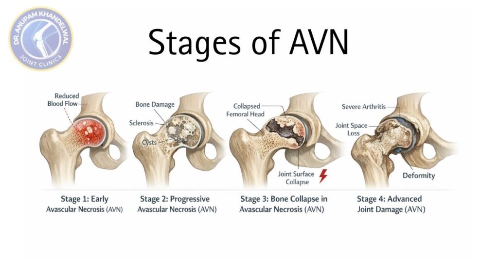 Stages of Avascular Necrosis AVN of the hip joint showing early reduced blood supply, progressive bone damage, femoral head collapse, and advanced joint destruction