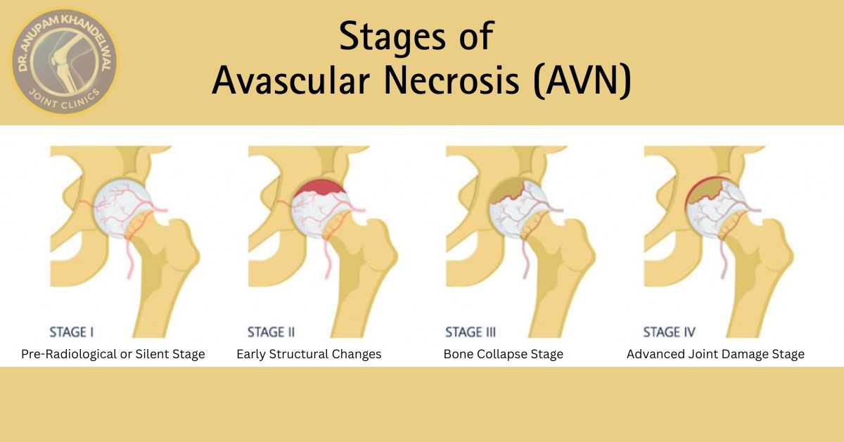 Diagram showing different stages of Avascular Necrosis (AVN) and progression of joint damage