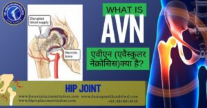 What is Avascular Necrosis ( AVN ) ?