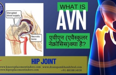 Illustration showing Avascular Necrosis (AVN) inside the bone