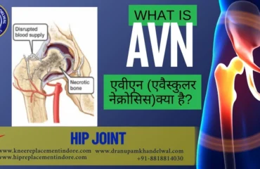 Illustration showing Avascular Necrosis (AVN) inside the bone
