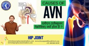 Causes of AVN: – Avascular Necrosis (AVN) Dr. in Indore