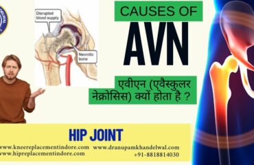 “Causes of AVN”