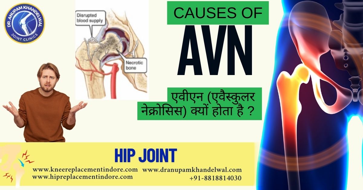 “Causes of AVN”