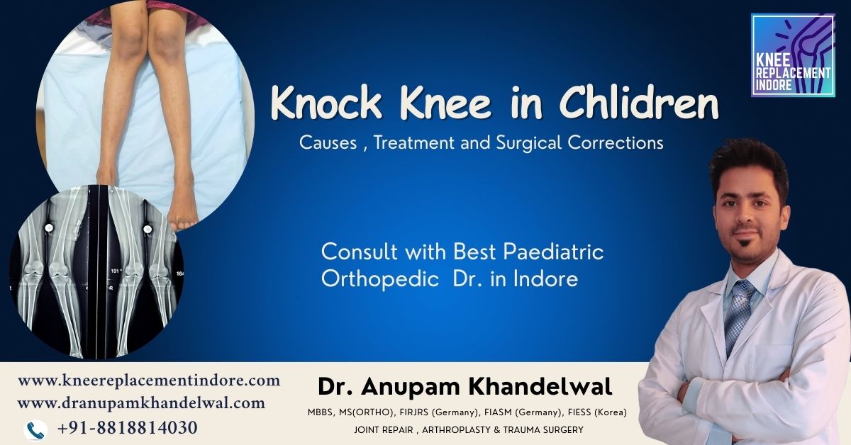 Knock knees in children – early diagnosis and treatment in Indore
