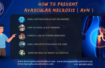 How to prevent Avascular Necrosis (AVN).