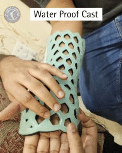 Orthopedic waterproof cast with open lattice design used for fracture treatment in Indore