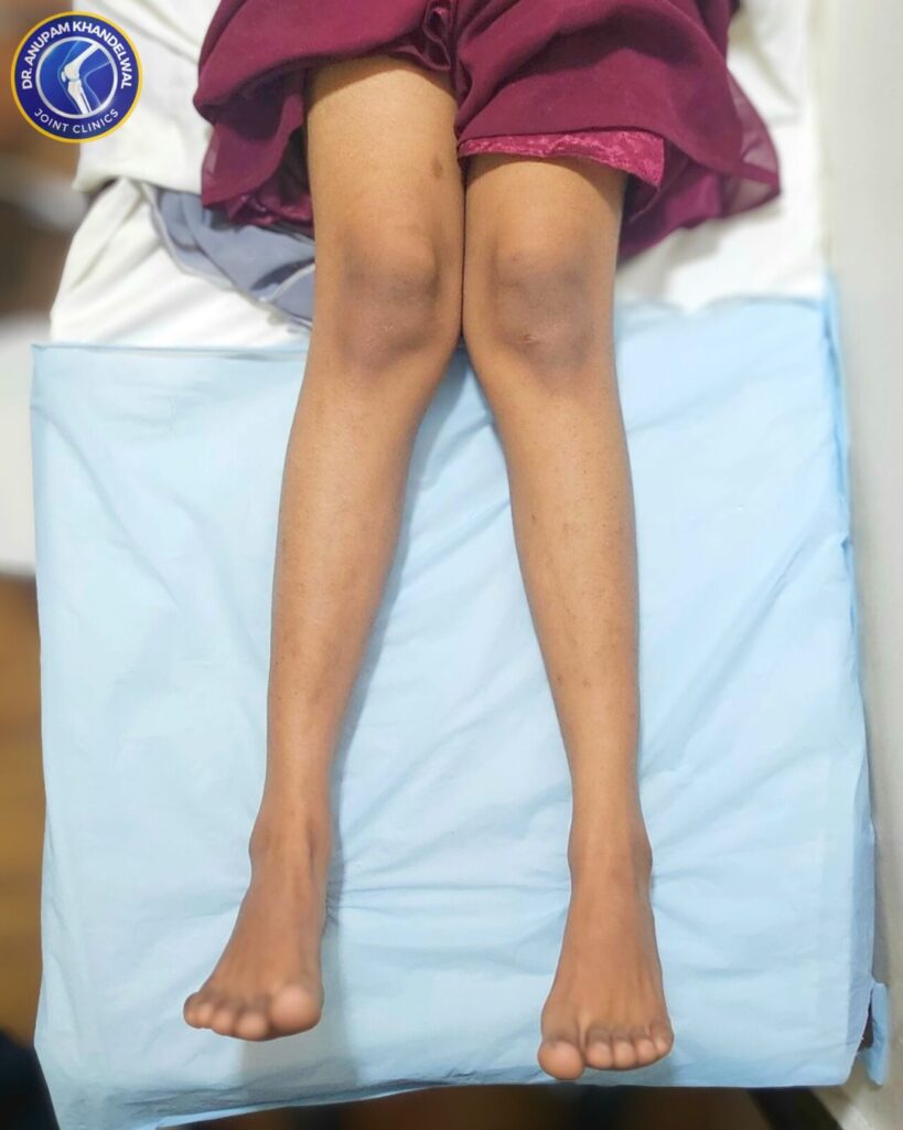 Clinical appearance of knock knees in children with inward knee positioning
