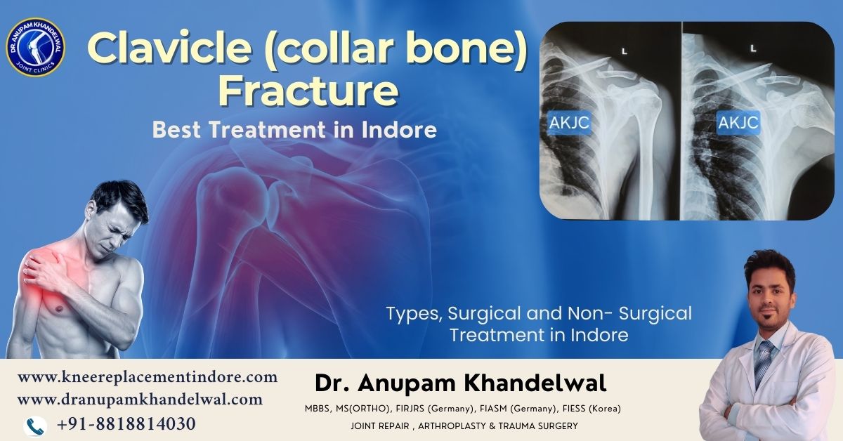 Clavicle Fracture Treatment in Indore showing displaced collar bone fracture managed by orthopedic surgeon