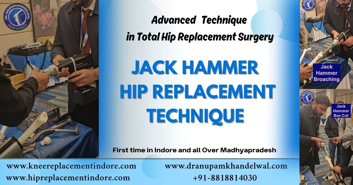 Jack Hammer Hip Replacement Technique in Indore performed by Dr. Anupam Khandelwal using advanced femur preparation method