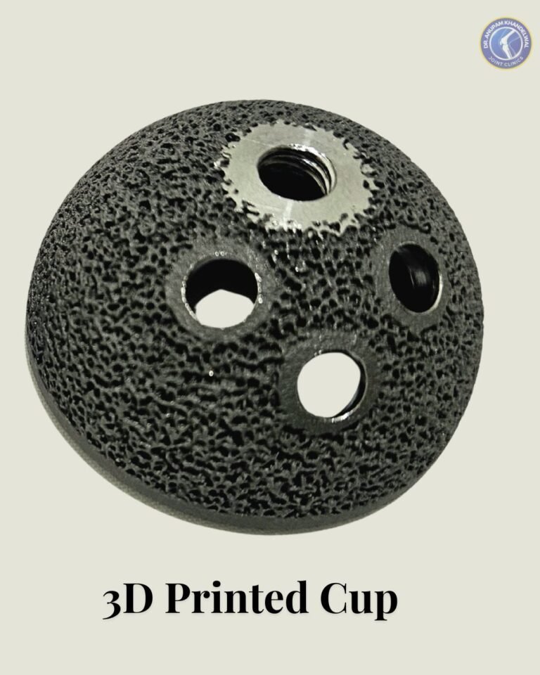 3D Printed Acetabular Cup Implant with porous trabecular design used in Hip Replacement Surgery as an advanced हिप रिप्लेसमेंट इम्प्लांट के प्रकार.