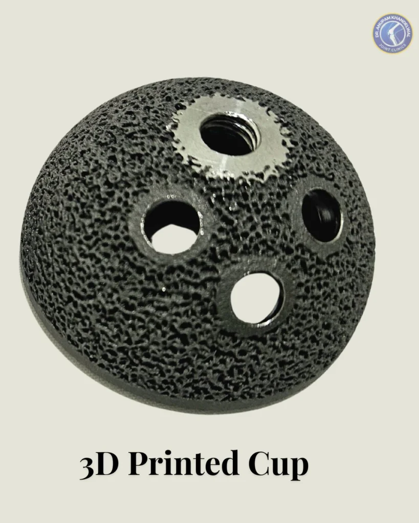 3D Printed Acetabular Cup Implant with porous trabecular design used in Hip Replacement Surgery as an advanced हिप रिप्लेसमेंट इम्प्लांट के प्रकार.