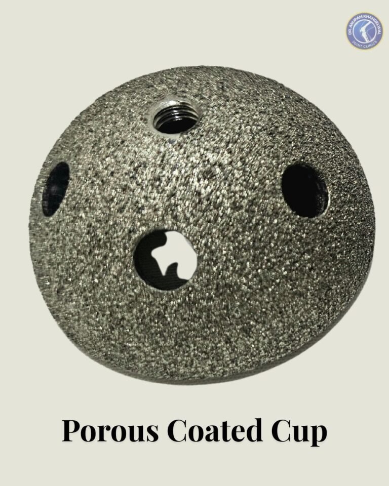 Porous Coated Acetabular Cup Implant with porous surface for bone ingrowth, used in Hip Replacement Surgery as one of the आधुनिक हिप रिप्लेसमेंट इम्प्लांट के प्रकार.