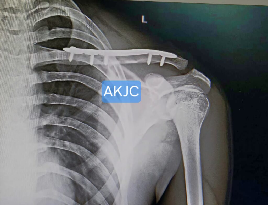 clavicle xray showing locking plate clavicle fixed by dr. anupam khandelwal
