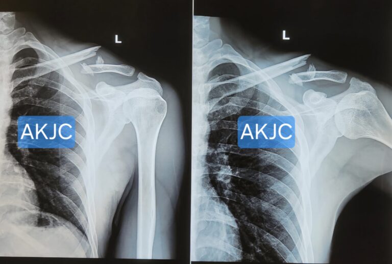 Displaced middle shaft clavicle fracture X-ray before surgery in Indore