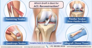ACL – Which graft is best in ACL Reconstruction Surgery ? Dr. Anupam Khandelwal, Indore