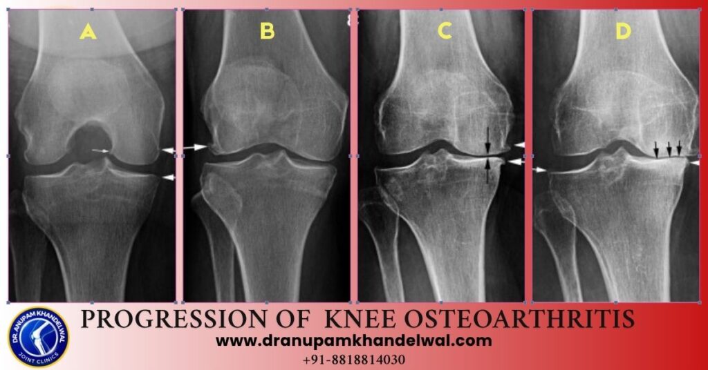 Dr. Anupam Khandelwal - Stages Of Osteoarthritis Knee
