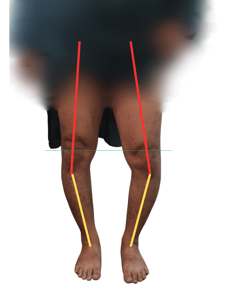 Lines drawn over patient legs to show extra -articular Deformity of Tibia - Case for HTO