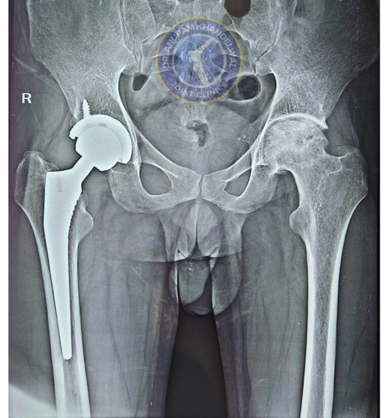 X-ray Showing Right side Operated LASER HIP REPLACEMENT with Left Side Hip AVN Pending for Surgery in a 34 year old patient from Ratlam