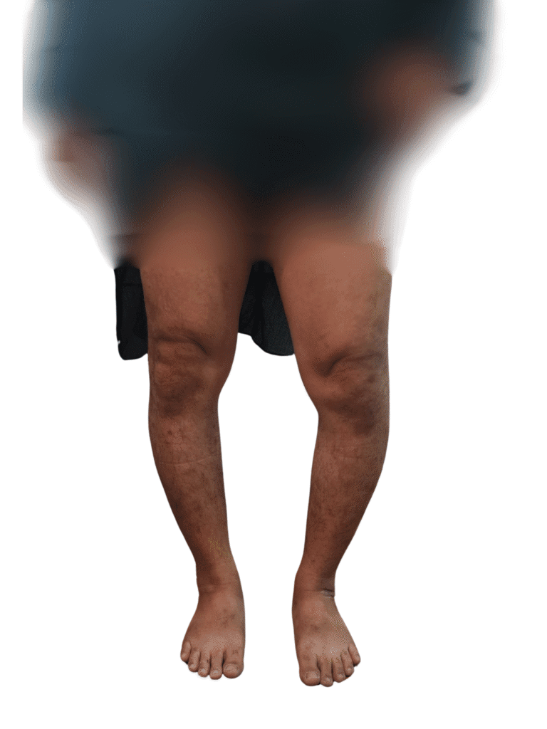 Patient Picture showing Knee Deformity extra-articular