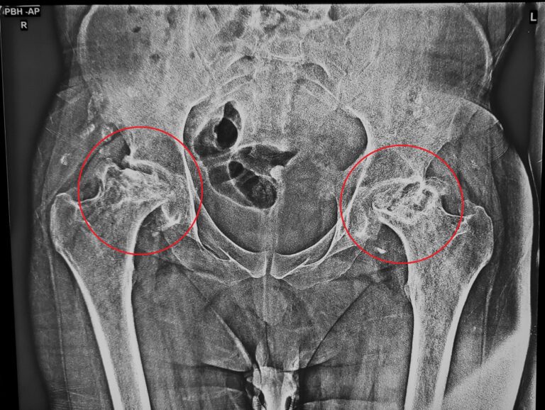 Dr. Anupam Khandelwal - Billateral Stage 4 hip AVN