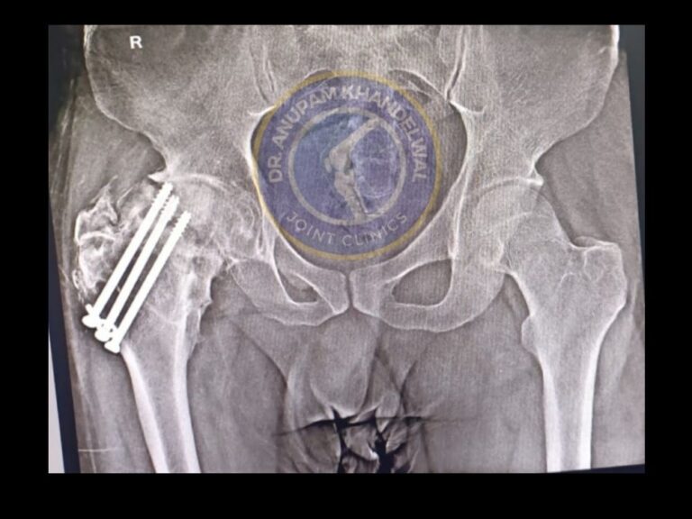X-ray Showing AVN / Hip OA with Screws in side Hip Joint - Hip replacement done by Dr. Anupam Khandelwal