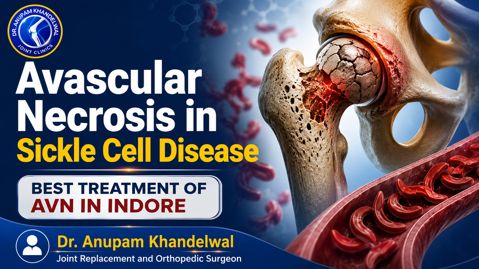 Featured medical illustration showing Avascular Necrosis in Sickle Cell Disease with a comparison of a healthy hip joint and an AVN-affected hip caused by reduced blood supply from sickle-shaped red blood cells.