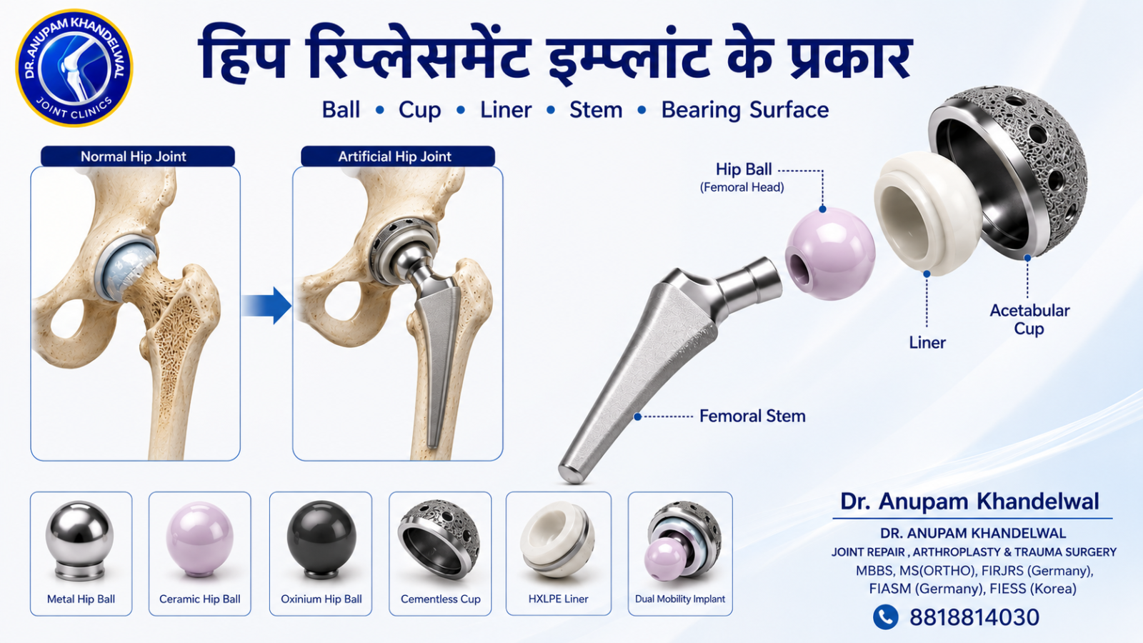 हिप रिप्लेसमेंट इम्प्लांट के प्रकार (Hip Replacement Implant Types) दर्शाने वाला चित्र, जिसमें Hip Ball, Acetabular Cup, Liner, Femoral Stem और Bearing Surface के मुख्य भाग दिखाए गए हैं।