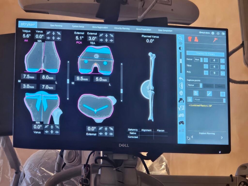 Dr. Anupam Khandelwal discussing knee balancing and bone cut planning during Robotic Knee Replacement Surgery with international arthroplasty surgeons at CCA 2026 AIIMS New Delhi.Dr. Anupam Khandelwal discussing knee balancing and bone cut planning during Robotic Knee Replacement Surgery with international arthroplasty surgeons at CCA 2026 AIIMS New Delhi.