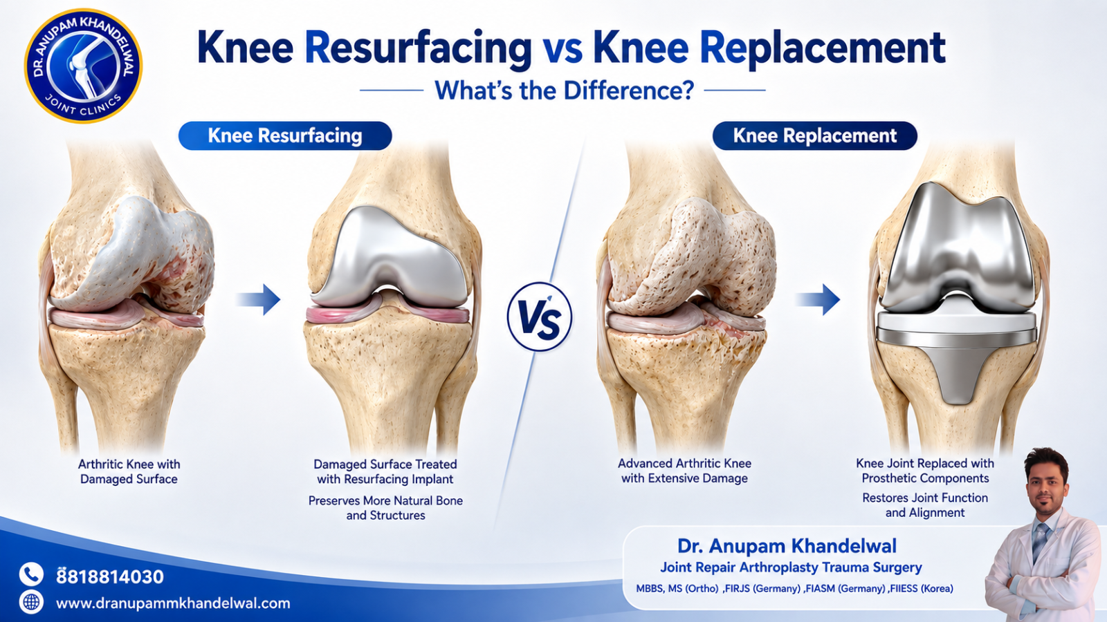 Knee resurfacing vs knee replacement showing differences between resurfacing and replacement procedures