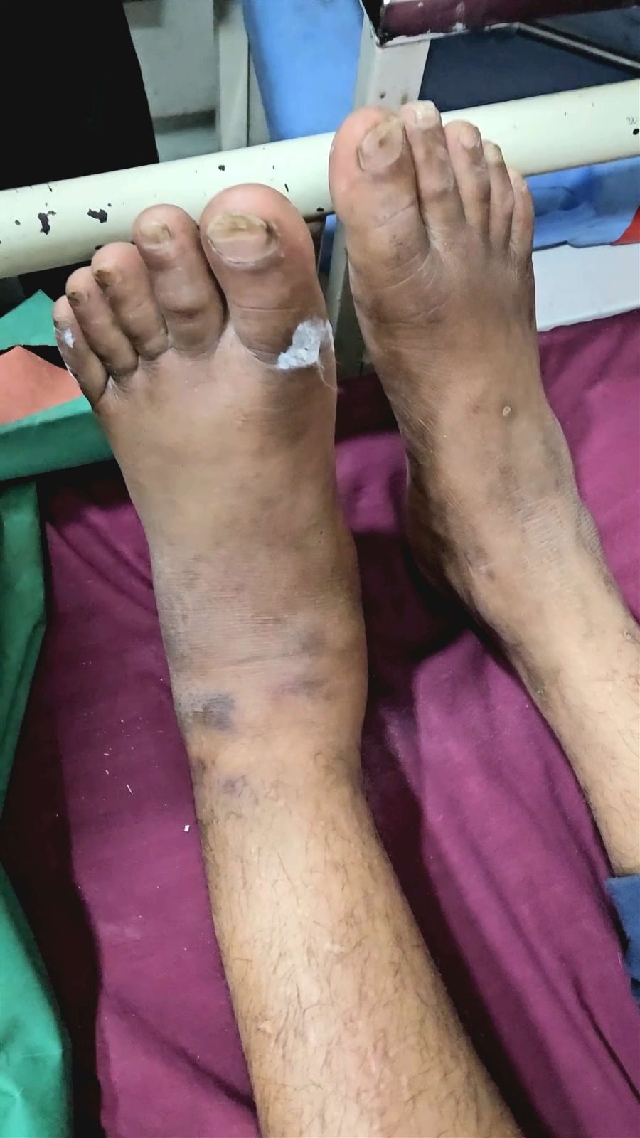 Gross ankle swelling in ankle fracture