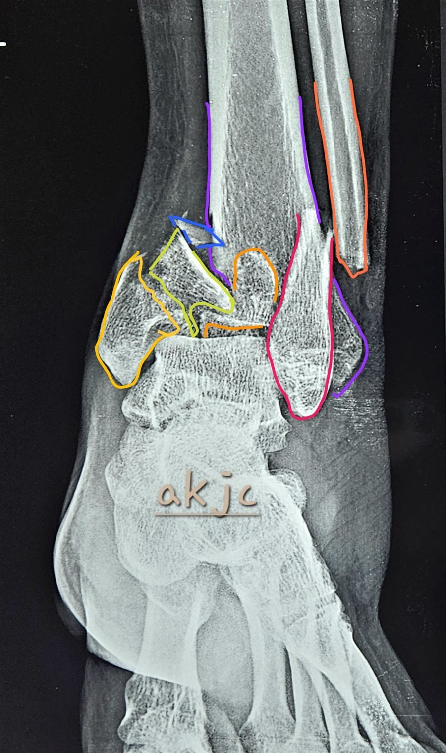 Tibial plafond fracture AP line diagram