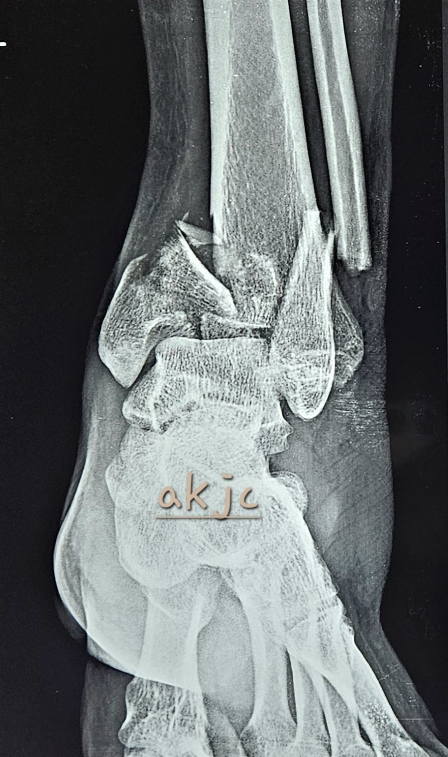 Tibial plafond fracture AP X-ray view