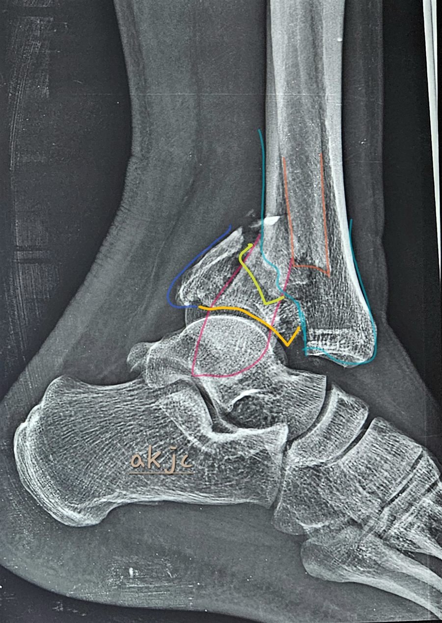 Tibial plafond fracture lateral line diagram