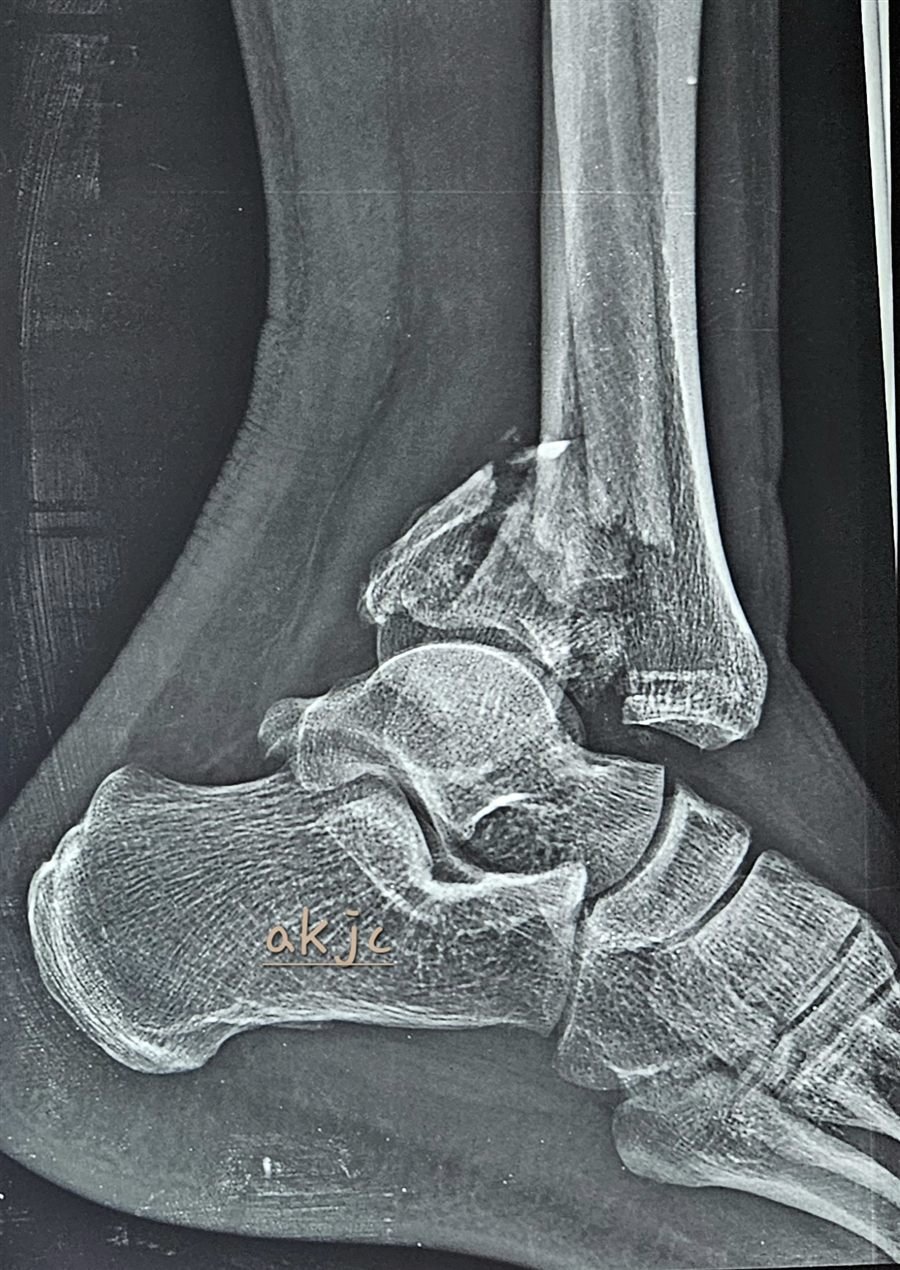 Tibial plafond fracture lateral X-ray view