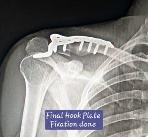 Non-Union of Lateral End Clavicle Fracture Treated with Revision Surgery in Indore