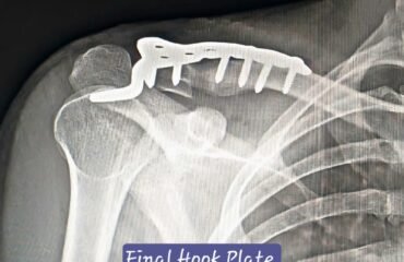 Post-operative X-ray after lateral clavicle plate fixation and bone grafting