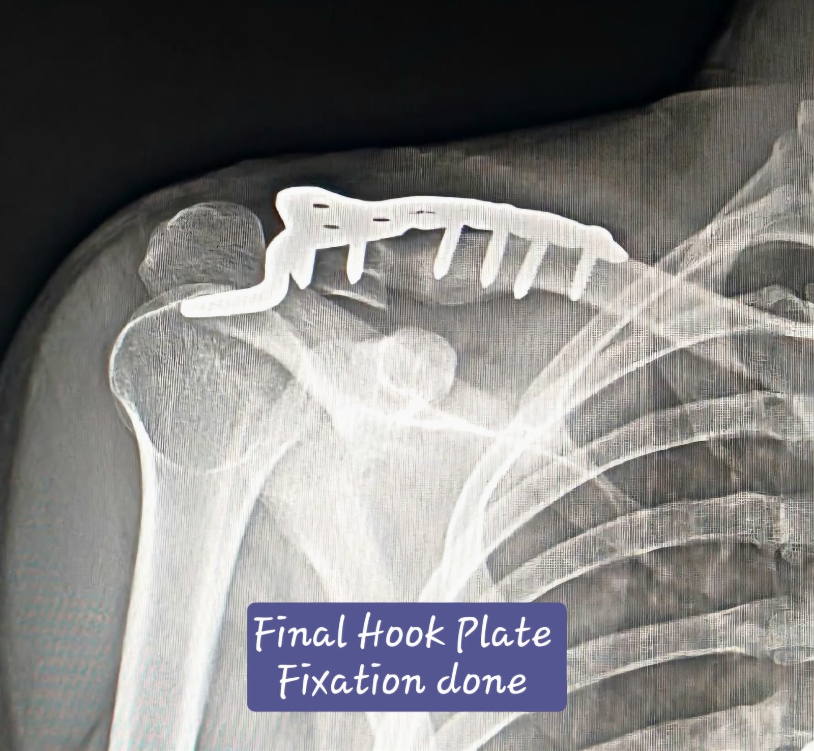 Post-operative X-ray after lateral clavicle plate fixation and bone grafting